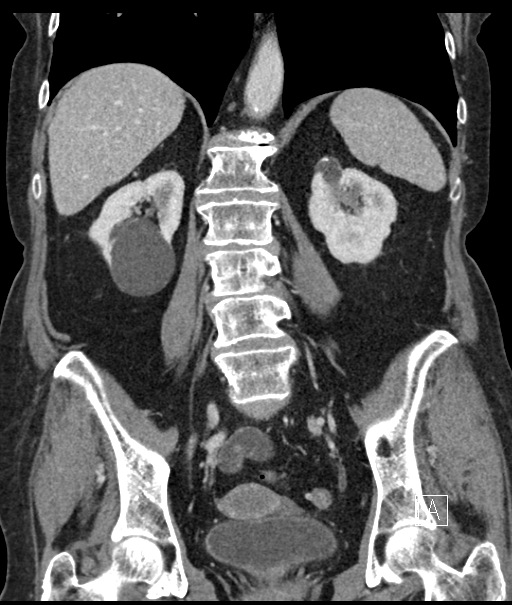 Calcified adrenal glands and Spigelian hernia (Radiopaedia 49741-54988 B 74).jpg