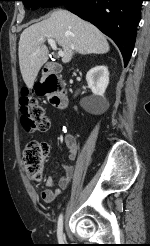 Calcified adrenal glands and Spigelian hernia (Radiopaedia 49741-54988 C 109).jpg
