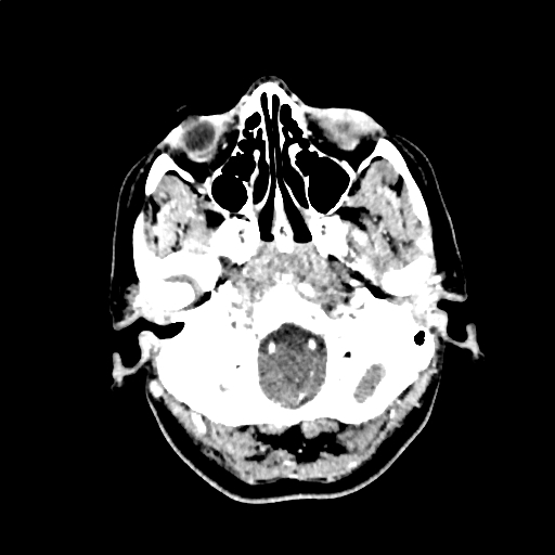 Calcified cerebral hydatid cyst (Radiopaedia 65603-74717 Axial with contrast 3).jpg