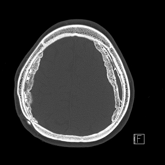 Calcified chronic subdural hematoma (Radiopaedia 77374-89492 Axial bone window 105).jpg