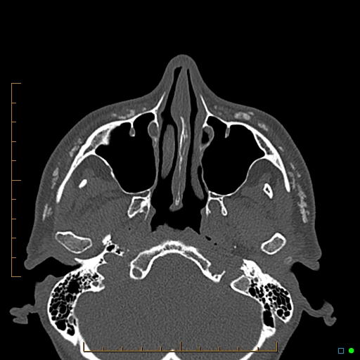 Calcified facial augmentation fillers (Radiopaedia 79514-92679 Axial bone window 24).jpg