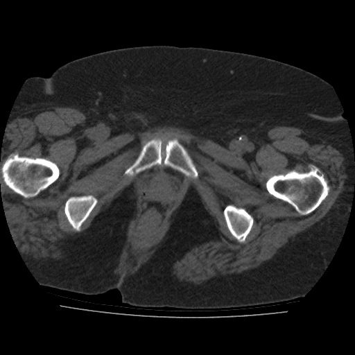File:Calcified fibroids (Radiopaedia 16853-16579 non-contrast 19).jpg