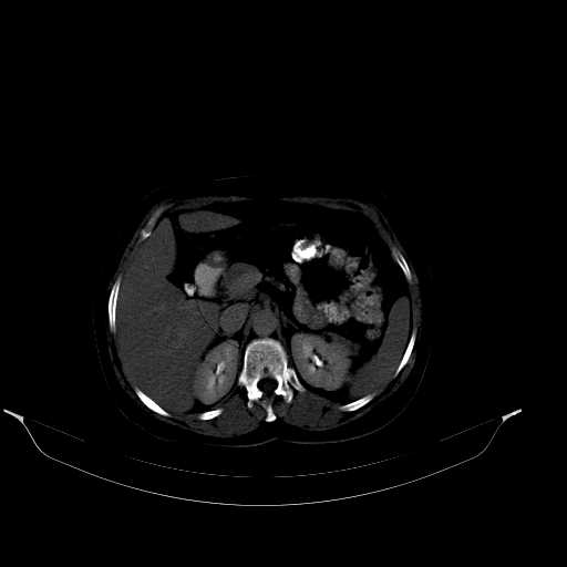 File:Calcified hydatid cyst of the liver (Radiopaedia 21212-21112 Axial bone window 18).jpg
