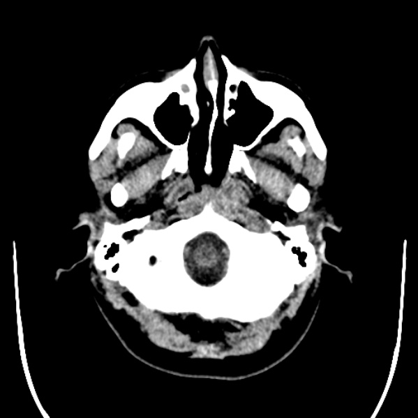 Calvarial osteoma (Radiopaedia 36520-38079 Axial non-contrast 6).jpg