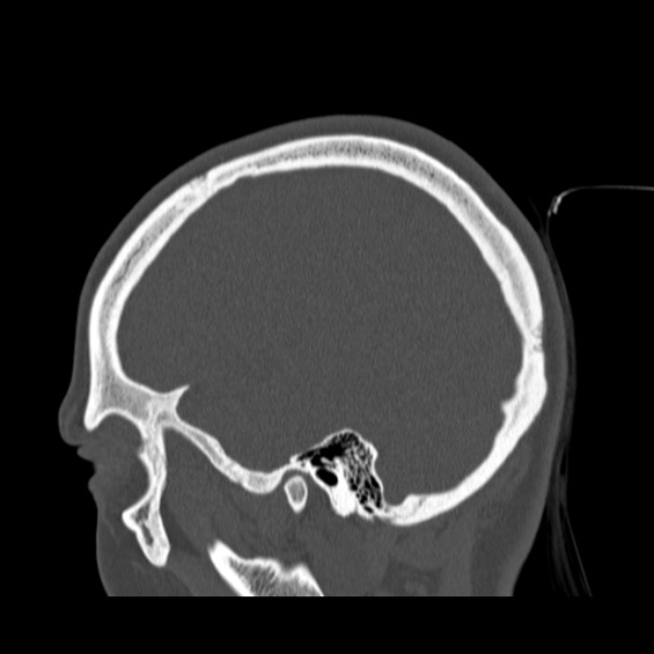 Calvarial osteoma (Radiopaedia 36520-38079 Sagittal bone window 84).jpg