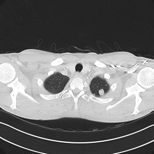 Cannonball metastases - testicular choriocarcinoma (Radiopaedia 84510-99891 Axial lung window 12).jpg