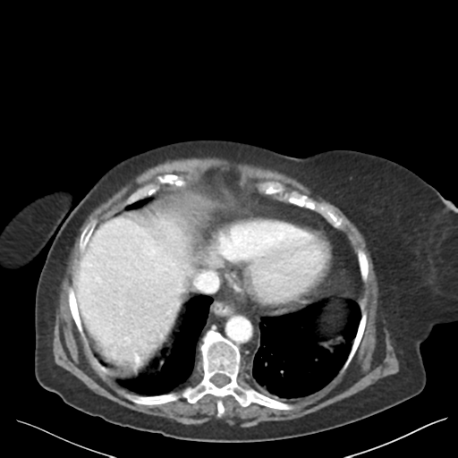 Cannonball metastases from endometrial cancer (Radiopaedia 42003-45031 E 11).png
