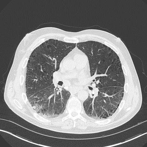 Caplan syndrome (Radiopaedia 56667-63530 Axial lung window 105).jpg