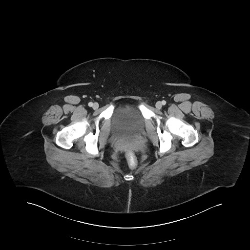 Carcinoid tumor - terminal ileum (Radiopaedia 60931-68739 A 134).jpg