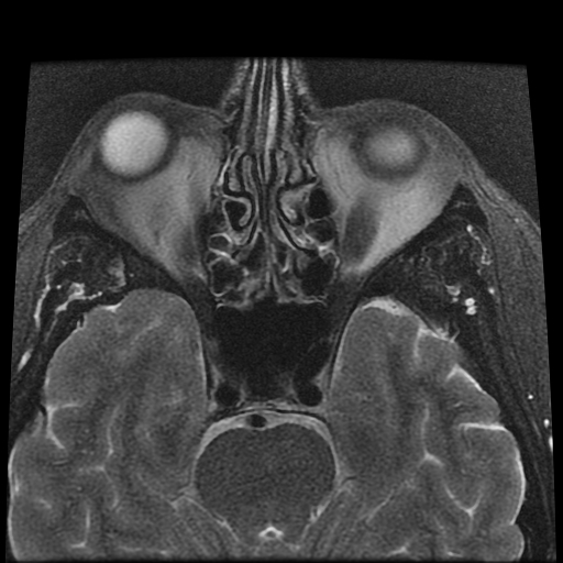 File:Carcinoid tumor of the ileum with metastasis to orbit (Radiopaedia 28165-28424 Axial T2 7).jpg