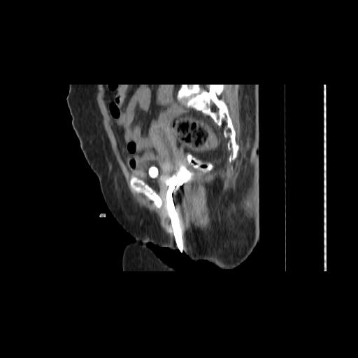 File:Carcinoma cervix- brachytherapy applicator (Radiopaedia 33135-34173 D 76).jpg