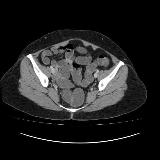 File:Carcinoma colon - hepatic flexure (Radiopaedia 19461-19493 A 108).jpg