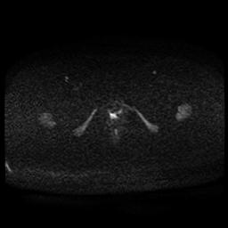 Carcinoma of the cervix (Radiopaedia 89018-105858 Axial DWI 45).jpg