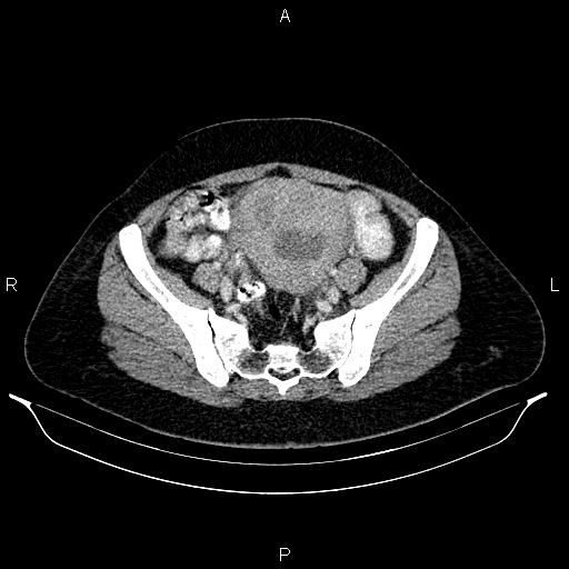 Carcinoma of uterine cervix (Radiopaedia 85861-101700 A 64).jpg