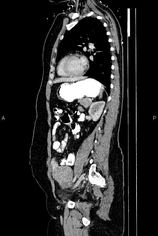 Carcinoma of uterine cervix (Radiopaedia 85861-101700 D 56).jpg