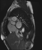 Cardiac amyloidosis (Radiopaedia 51404-57150 Sagittal CINE SSFP 282).jpg
