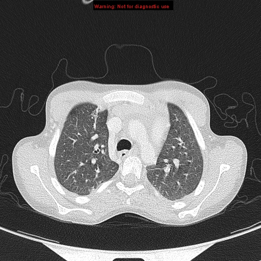 File:Cardiac bronchus (Radiopaedia 14059-13899 A 1).jpg