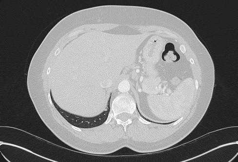 File:Cardiac sarcoidosis (Radiopaedia 74548-85534 Axial lung window 87).jpg