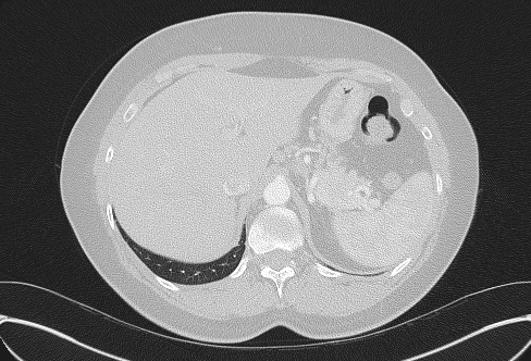 Cardiac sarcoidosis (Radiopaedia 74548-85534 Axial lung window 88).jpg