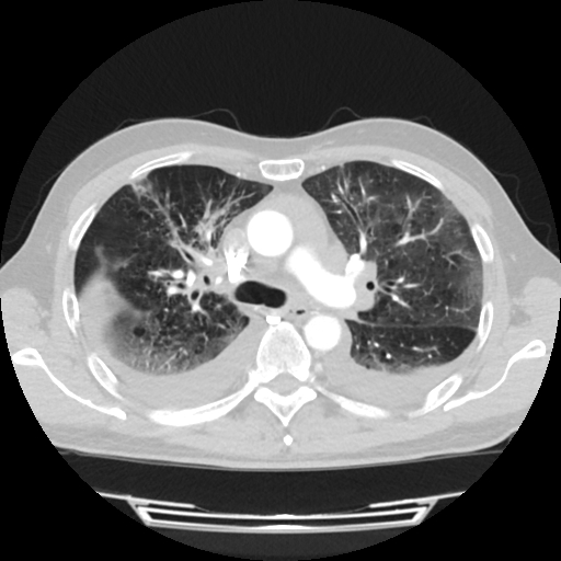 Cardiac tamponade (Radiopaedia 78607-91368 Axial lung window 29).jpg
