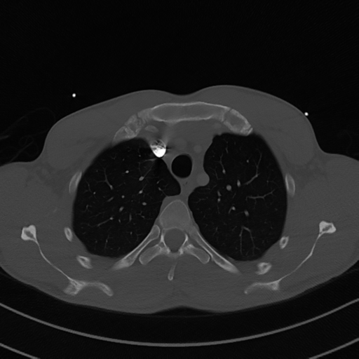 File:Cardiac tumor - undifferentiated pleomorphic sarcoma (Radiopaedia 45844-50134 Axial bone window 16).png