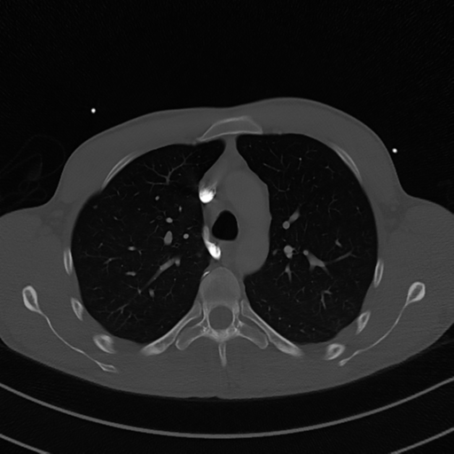 File:Cardiac tumor - undifferentiated pleomorphic sarcoma (Radiopaedia 45844-50134 Axial bone window 22).png