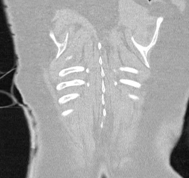 Cardiogenic pulmonary edema (Radiopaedia 29213-29609 Coronal lung window 64).jpg