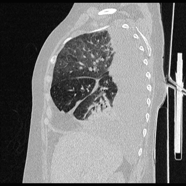 Cardiogenic pulmonary edema (Radiopaedia 29213-29609 Sagittal lung window 29).jpg