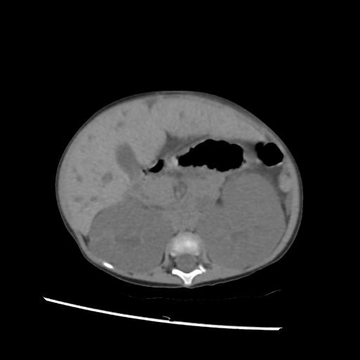File:Caroli disease with autosomal recessive polycystic kidney disease (ARPKD) (Radiopaedia 89651-106703 Axial non-contrast 25).jpg
