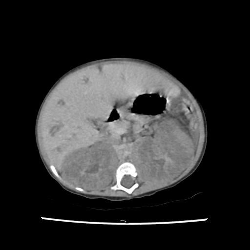 Caroli disease with autosomal recessive polycystic kidney disease (ARPKD) (Radiopaedia 89651-106703 B 88).jpg