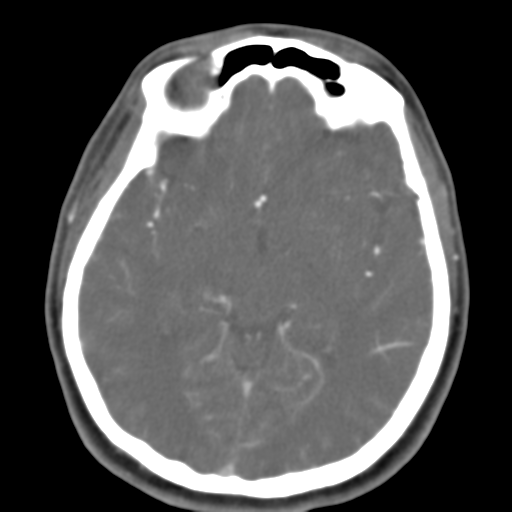 Carotico ophthalmic aneurysm (Radiopaedia 42916-46148 A 30).png