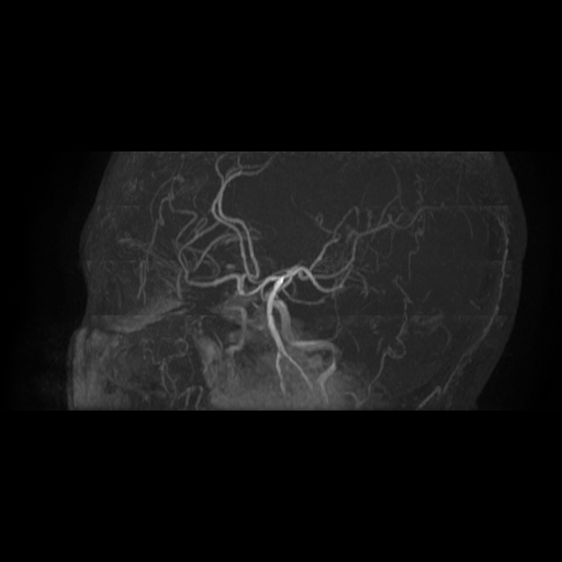 Carotid arterial dissection with acute cerebral infarction (Radiopaedia 26636-26784 MRA 7).jpg