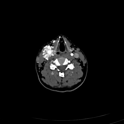 Carotid body tumor (Radiopaedia 83615-98727 A 71).jpg