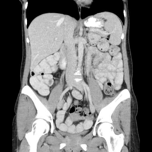 Castleman disease with fibrous pseudotumor in the abdomen (Radiopaedia 77296-89373 B 48).jpg