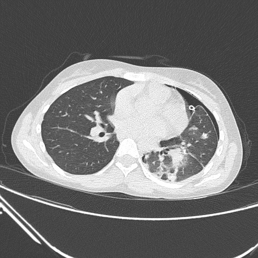 Catamenial pneumothorax (Radiopaedia 27946-28197 lung window 89).jpg
