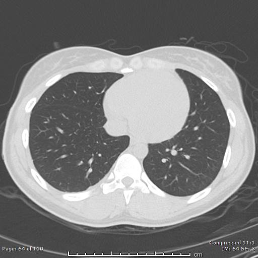 Catamenial pneumothorax (Radiopaedia 54382-60600 Axial non-contrast 64).jpg