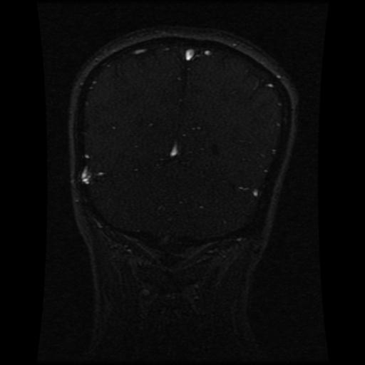 Cavernoma with developmental venous anomaly (Radiopaedia 22470-22507 MRV 45).jpg
