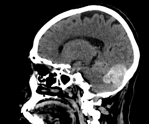 Cavernous hemangioma of the cerebellar falx (Radiopaedia 73025-83723 B 131).jpg