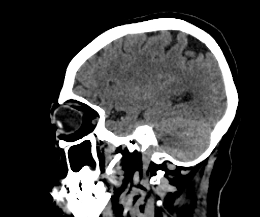 Cavernous hemangioma of the cerebellar falx (Radiopaedia 73025-83723 B 98).jpg