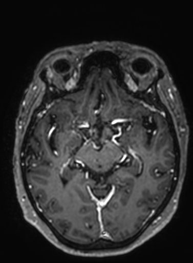 File:Cavernous hemangioma of the cerebellar falx (Radiopaedia 73025-83724 Axial T1 C+ 193).jpg