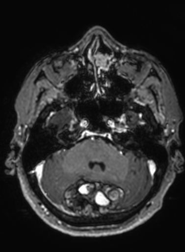 Cavernous hemangioma of the cerebellar falx (Radiopaedia 73025-83724 Axial T1 C+ 253).jpg