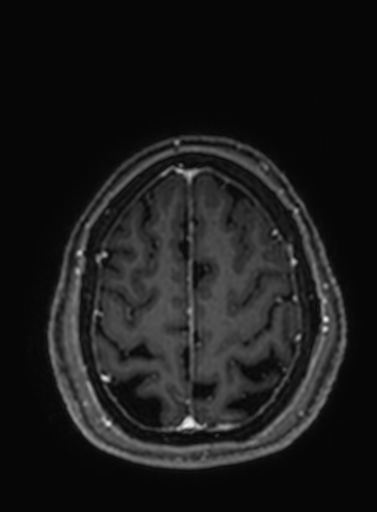 Cavernous hemangioma of the cerebellar falx (Radiopaedia 73025-83724 Axial T1 C+ 66).jpg