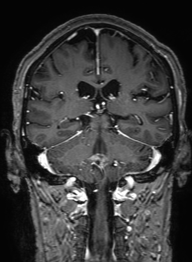 Cavernous hemangioma of the cerebellar falx (Radiopaedia 73025-83724 Coronal T1 C+ 235).jpg