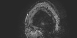 Cavernous hemangioma of the cerebellar falx (Radiopaedia 73025-83724 Sagittal BOLD 2).jpg