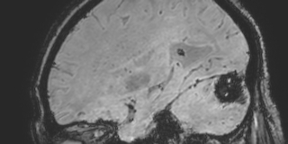 Cavernous hemangioma of the cerebellar falx (Radiopaedia 73025-83724 Sagittal BOLD 65).jpg