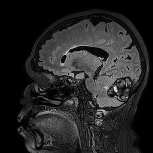 Cavernous hemangioma of the cerebellar falx (Radiopaedia 73025-83724 Sagittal FLAIR 132).jpg