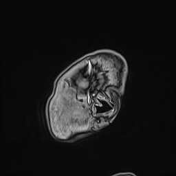 Cavernous sinus meningioma (Radiopaedia 63682-72367 Sagittal T1 C+ 18).jpg