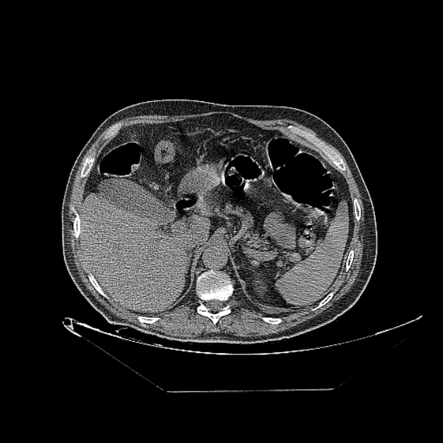 Cavitating bronchogenic carcinoma (Radiopaedia 44489-48162 Axial non-contrast 87).jpg