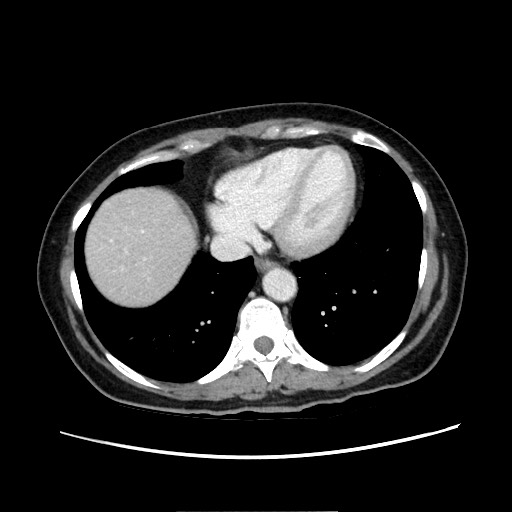 Cecal adenocarcinoma (Radiopaedia 75909-87331 A 14).jpg