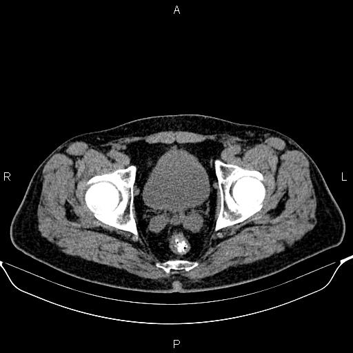 File:Cecal adenocarcinoma (Radiopaedia 85324-100916 Axial non-contrast 93).jpg